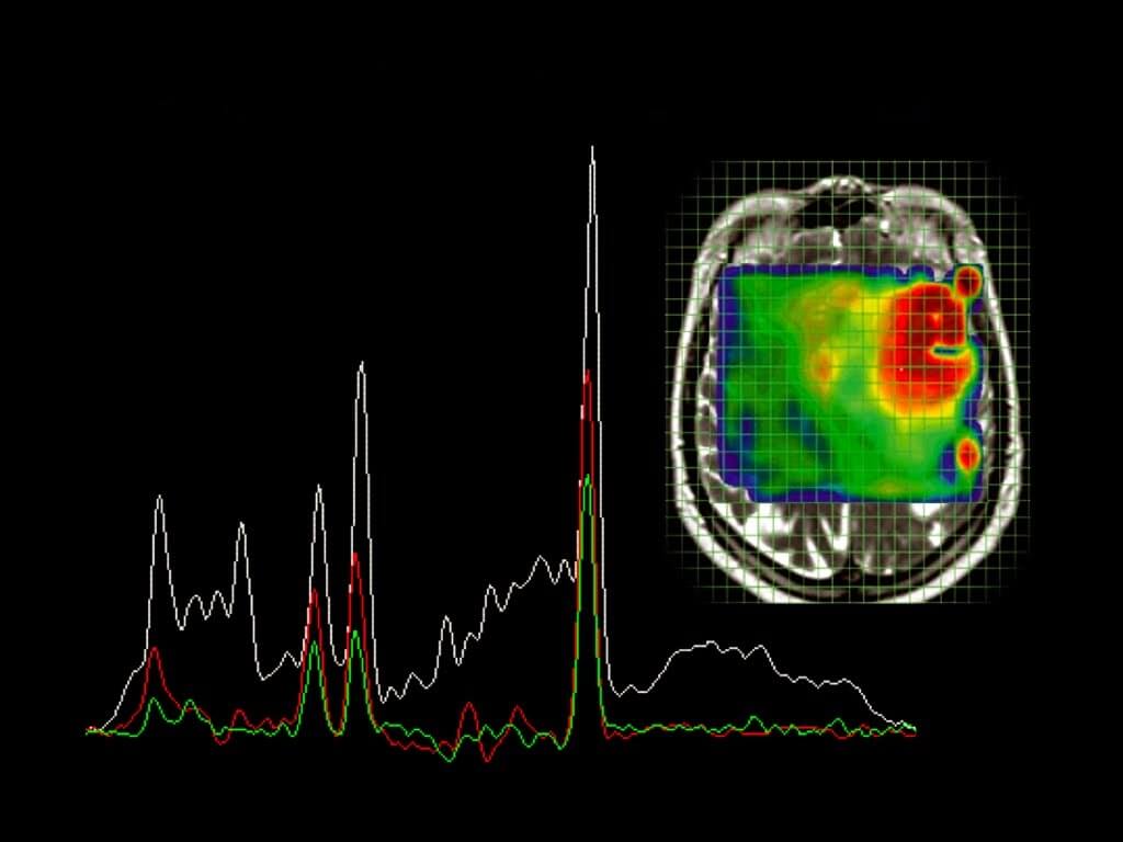Магнитно резонансная спектроскопия МРС что это и как проходит