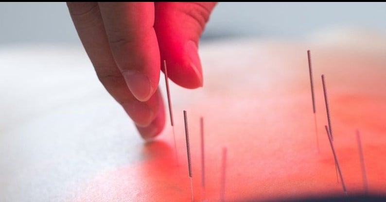 иглоукалывание